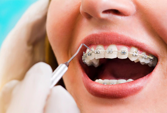 what-is-accelerated-orthodontics-outstanding-ortho-blog